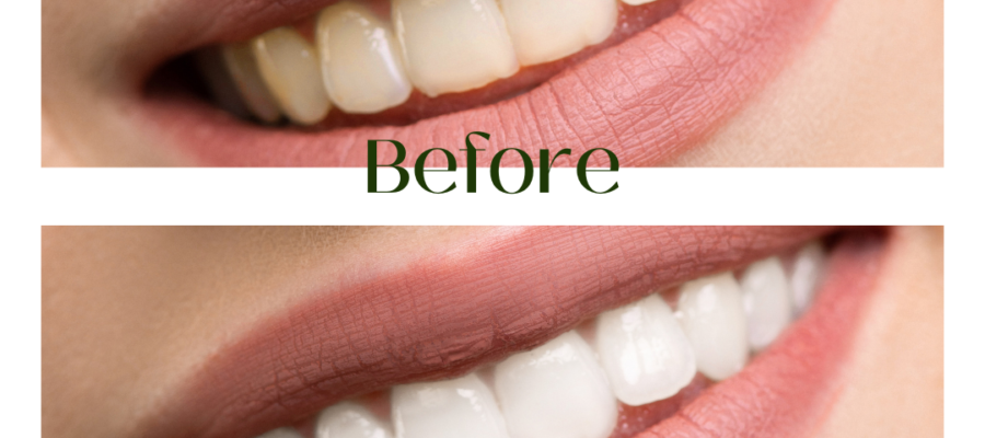 teeth discolouration