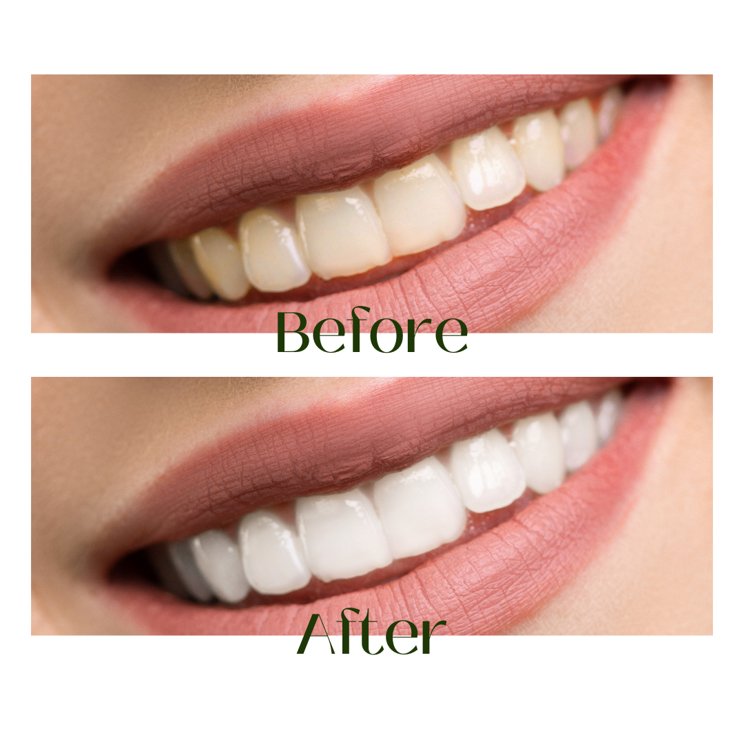 teeth discolouration