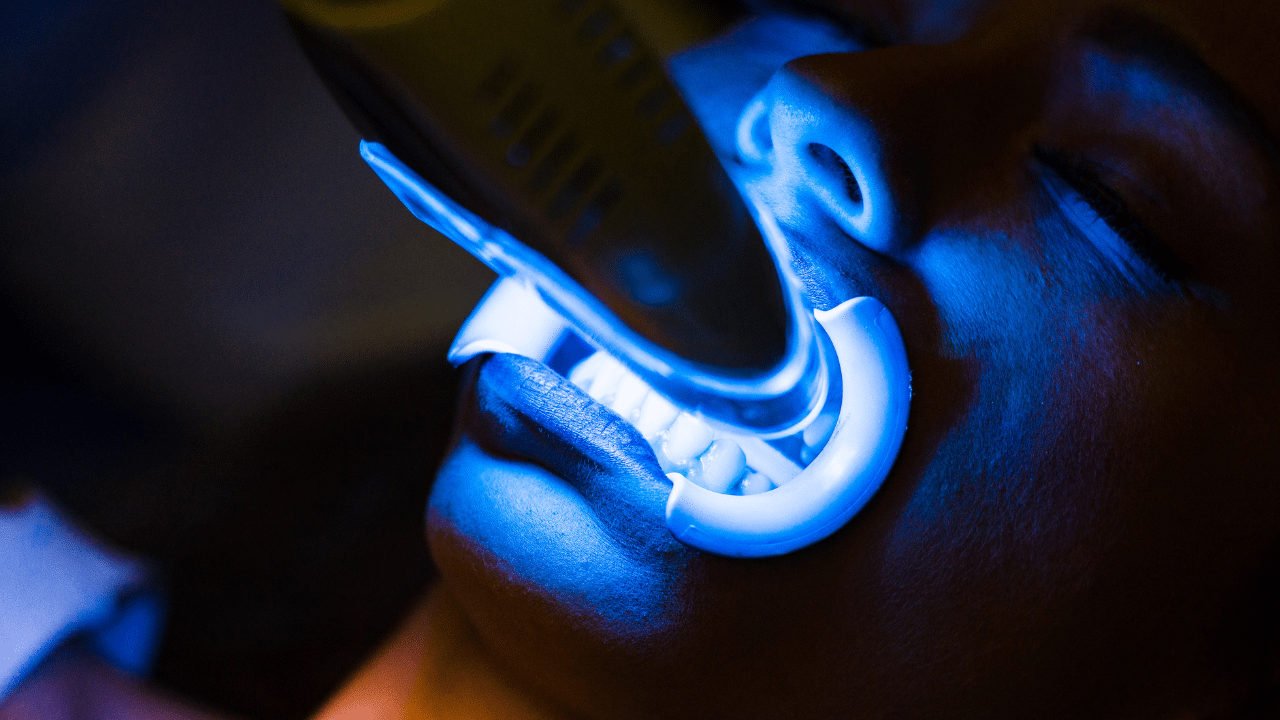 laser teeth whitening